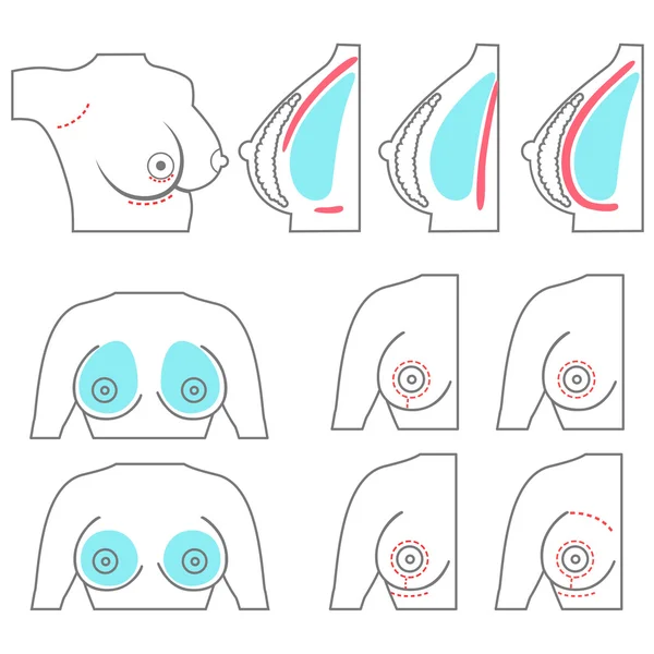 Ubicación y tipos de implantes mamarios, incisiones de lifting mamario — Archivo Imágenes Vectoriales